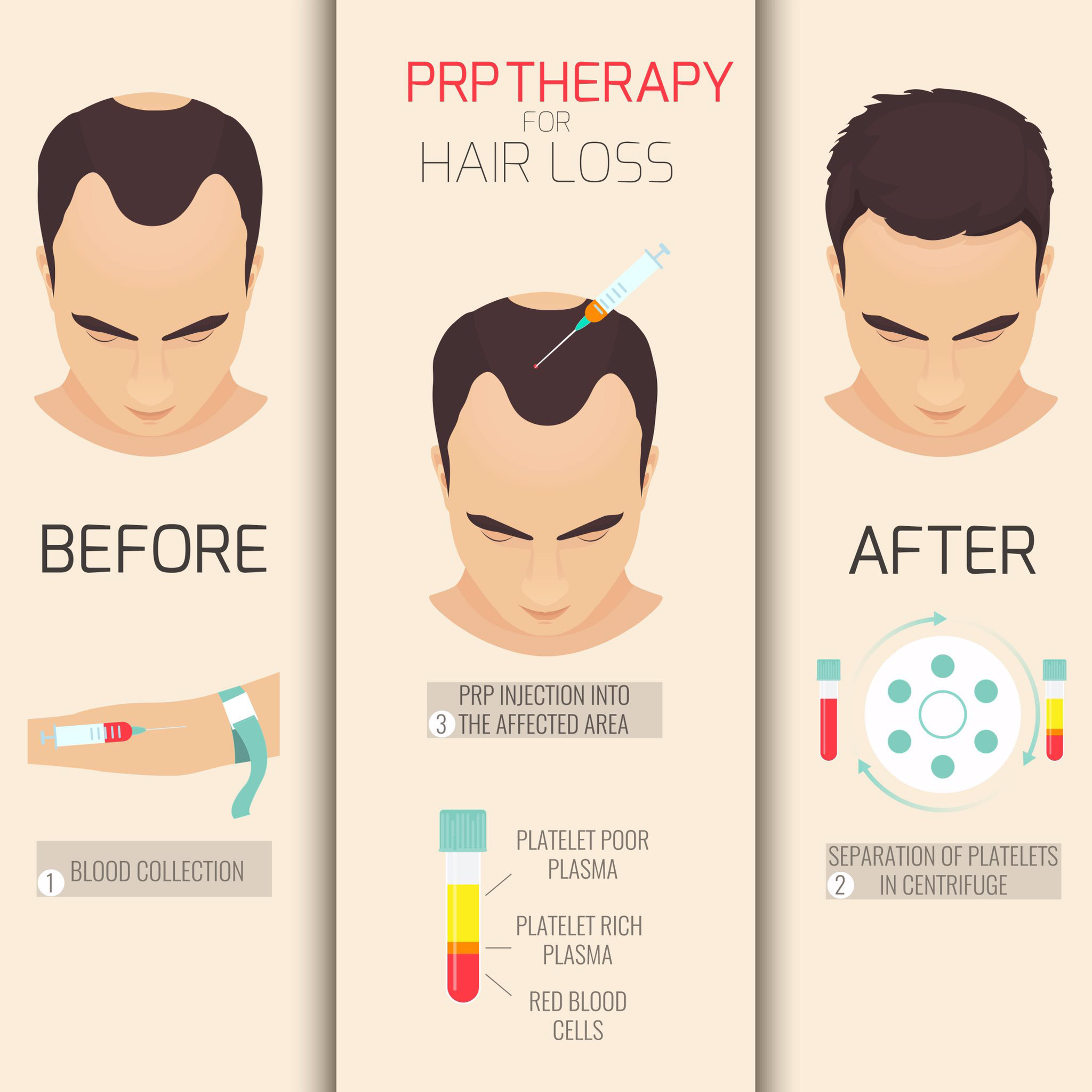 Prp Therapy As Hair Loss Treatment Kl Aesthetic Malaysia