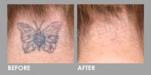 PICO Laser for tatto removal Before After